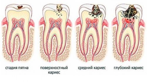 7 крамольных фактов о кариесе